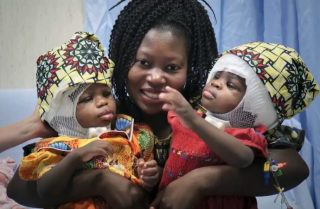 Сијамски близнаци се разделија во болницата во сопственост на Ватикан