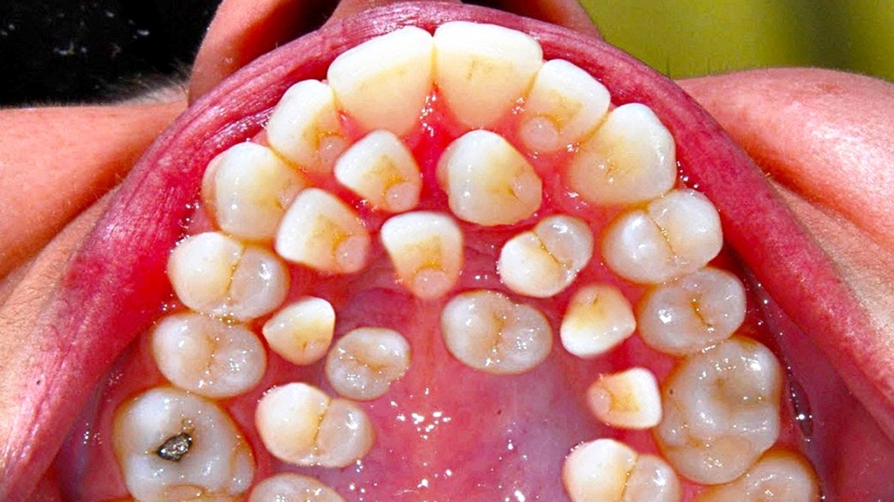 numero eccessivo di denti